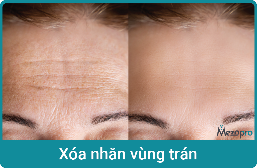 hq-xoa-nhan-vung-tran