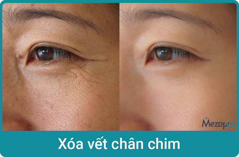 hq-xoa-vet-chân-chim