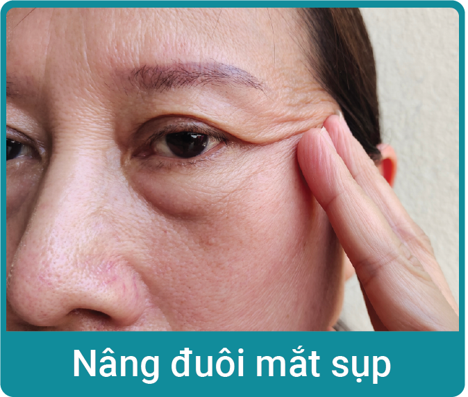 nang-duoi-mat-sup