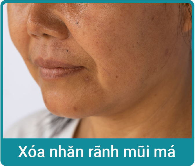 xoa-nhan-ranh-mui-ma