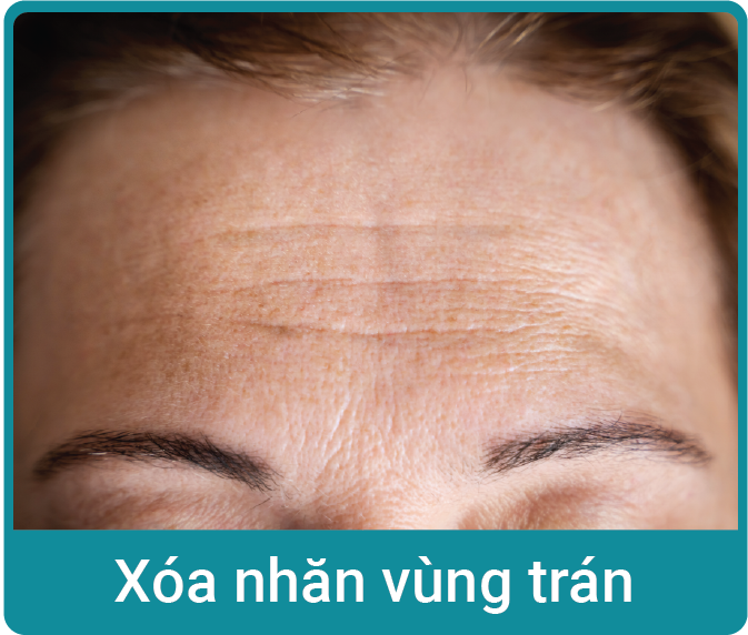 xoa-nhan-vung-tran